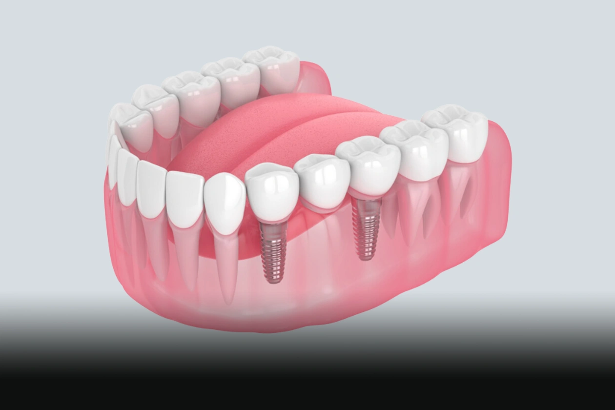 All In One Solution All-On-X Dental Implants | Dentist Greer & Easley, SC | Cove Dental Care